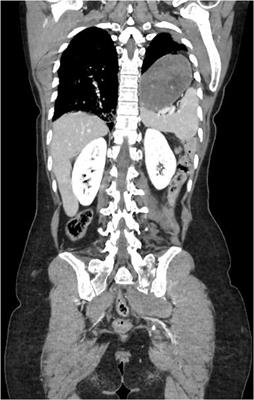 Blunt Trauma Associated With Bilateral Diaphragmatic Rupture: A Case Report